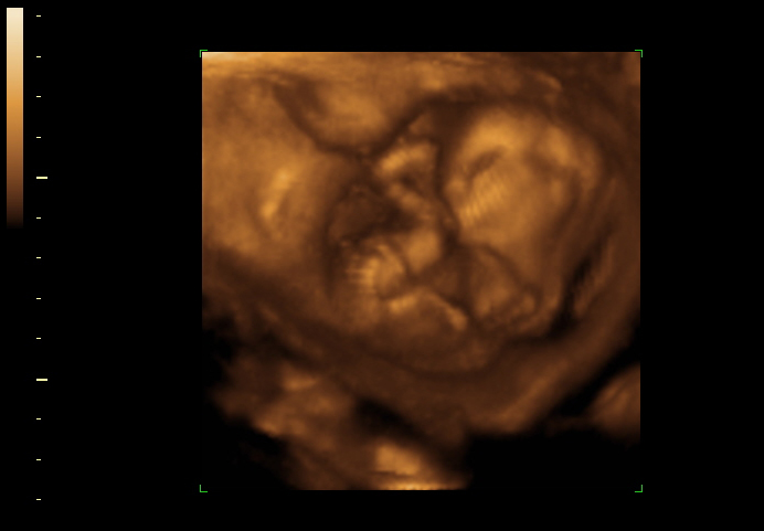3d sonogram image at 15 weeks
