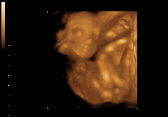 3d sonogram image at 20 weeks