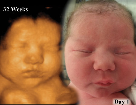3D ultrasound before and after