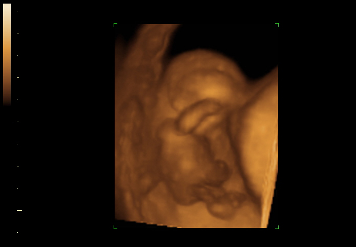 3d sonogram image at 11 weeks