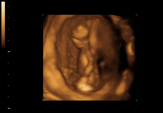 3d sonogram image at 13 weeks