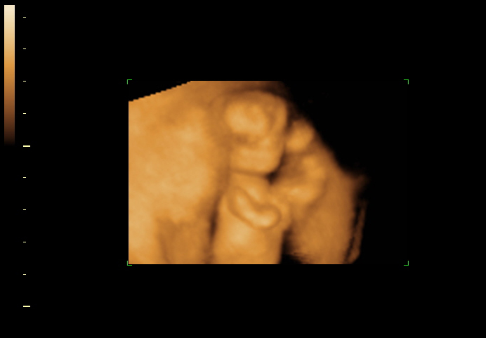 3d sonogram image at 13 weeks