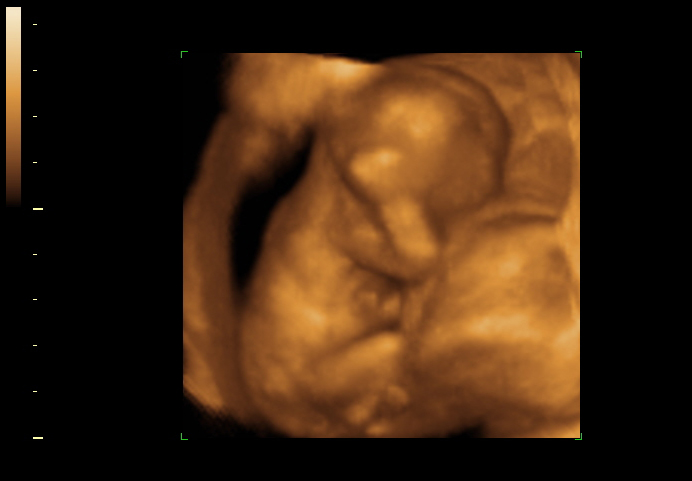 3d sonogram image at 14 weeks