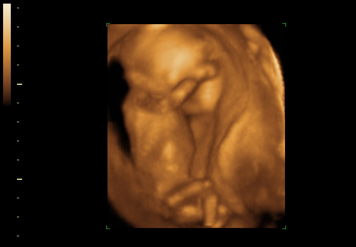 3d sonogram image at 17 weeks