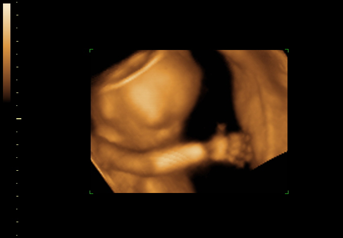 3d sonogram image at 17 weeks
