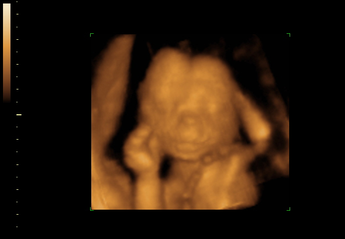 3d sonogram image at 18 weeks