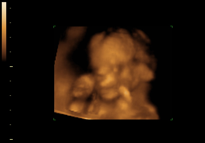 3d sonogram image at 18 weeks