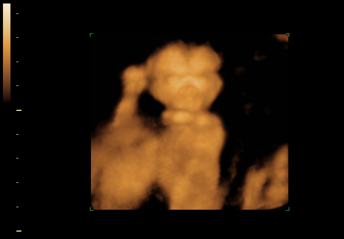 3d sonogram image at 18 weeks