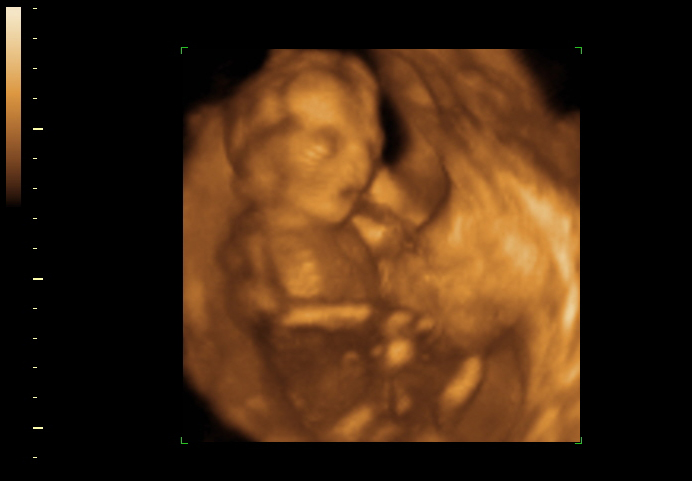 3d sonogram image at 18 weeks