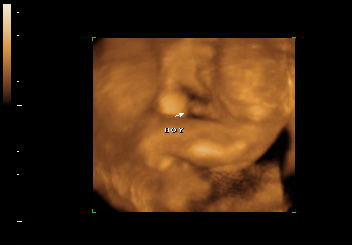 3d sonogram image at 20 weeks