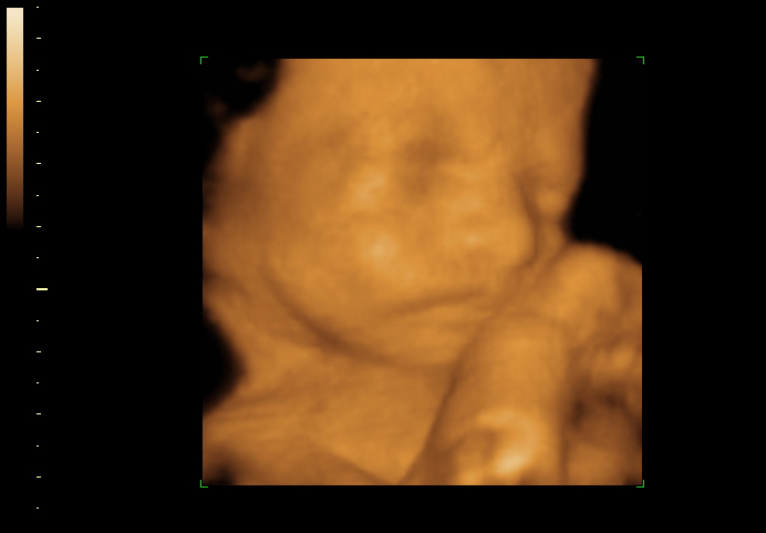 3d sonogram image at 25 weeks