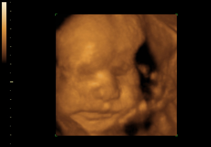3d sonogram image at 25 weeks