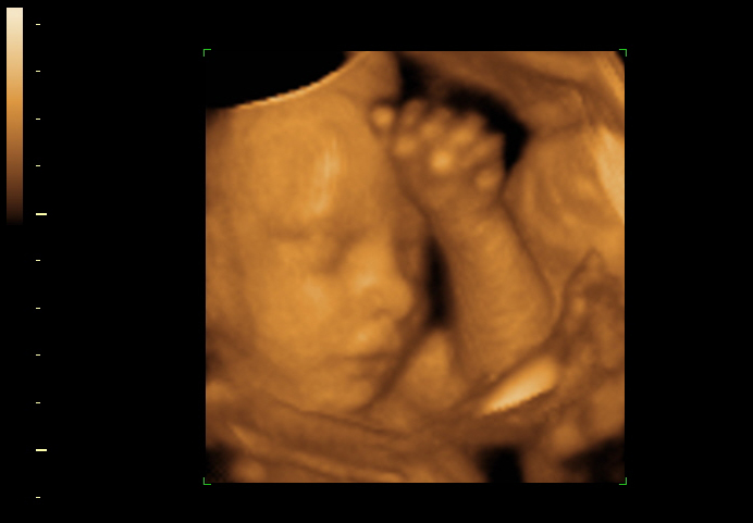 3d sonogram image at 25 weeks