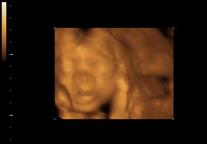 3d sonogram image at 25 weeks