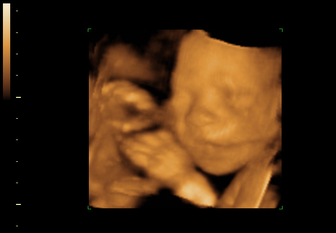 3d sonogram image at 25 weeks