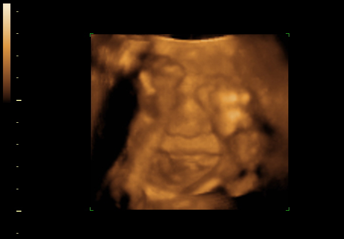 3d sonogram image at 26 weeks