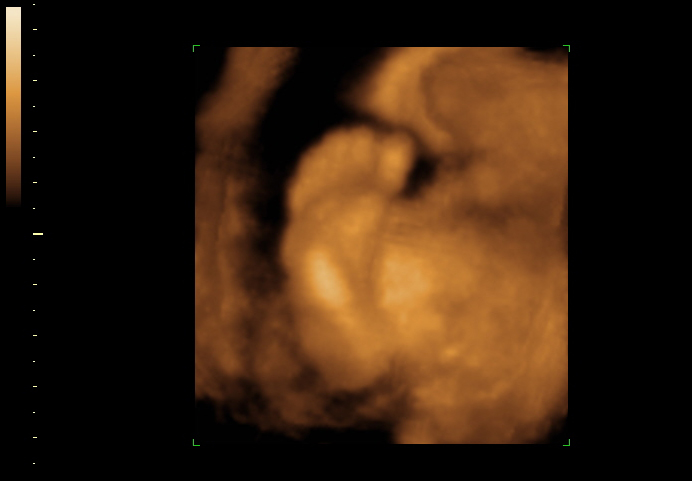 3d sonogram image at 26 weeks