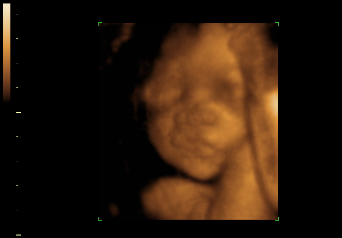 3d sonogram image at 26 weeks