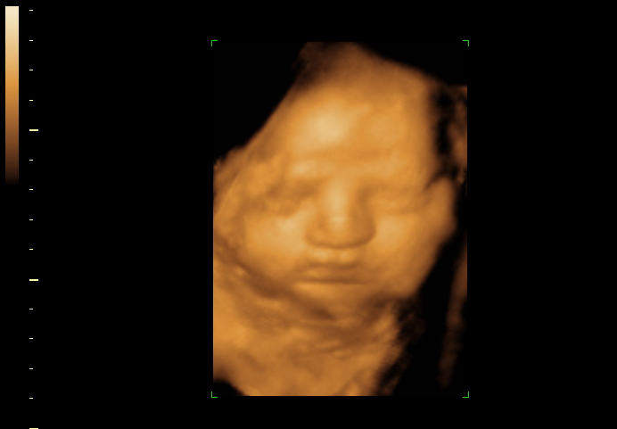 3d sonogram image at 31 weeks