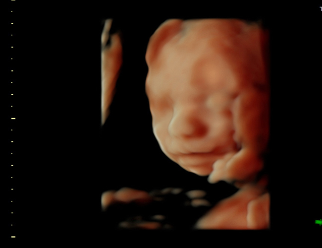 3d sonogram image at HD weeks