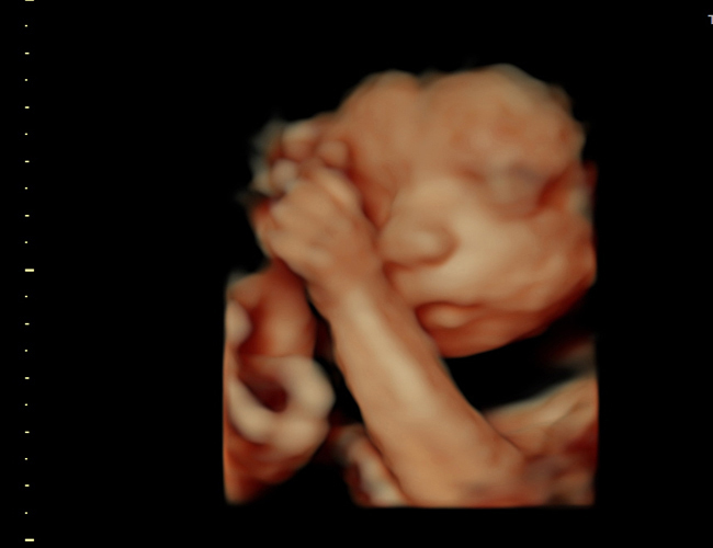 3d sonogram image at HD weeks