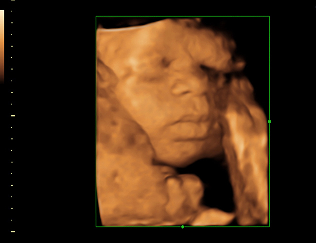 3d sonogram image at HD weeks