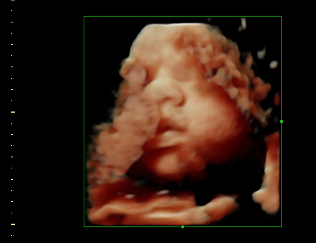 3d sonogram image at HD weeks