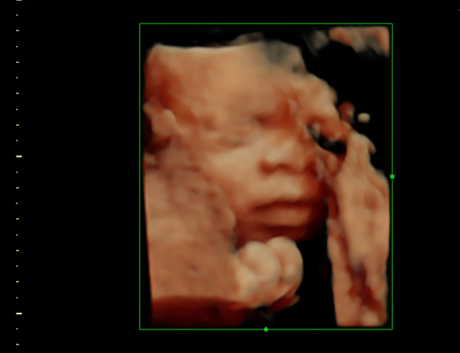 3d sonogram image at HD weeks