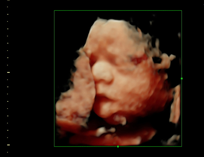 3d sonogram image at HD weeks