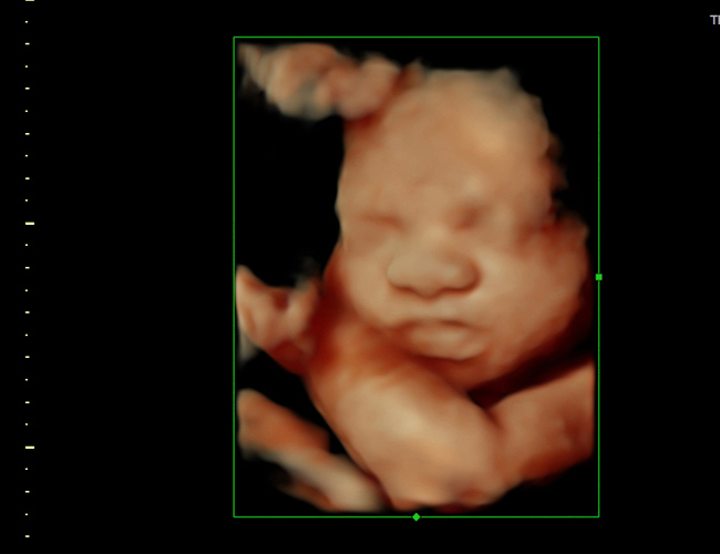 3d sonogram image at HD weeks