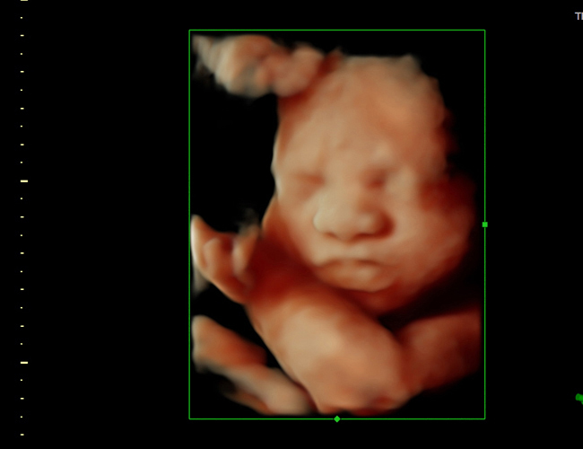 3d sonogram image at HD weeks