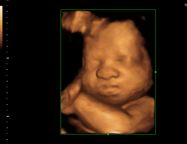 3d sonogram image at HD weeks