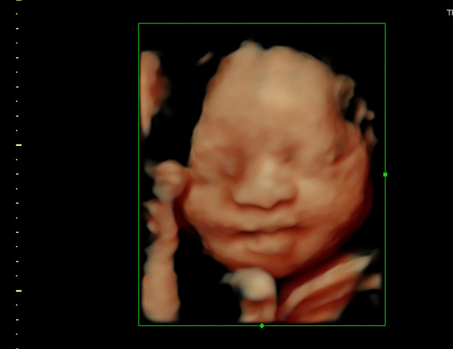 3d sonogram image at HD weeks