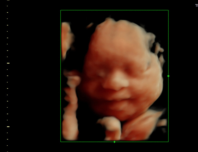 3d sonogram image at HD weeks