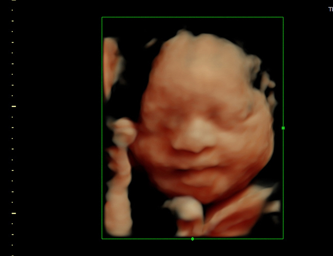 3d sonogram image at HD weeks