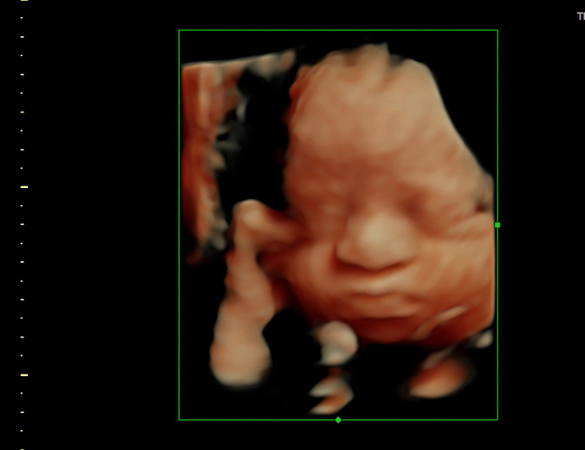 3d sonogram image at HD weeks