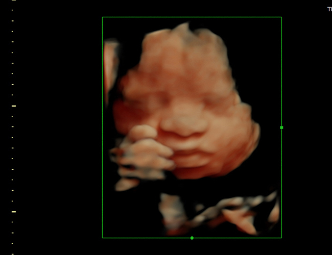 3d sonogram image at HD weeks