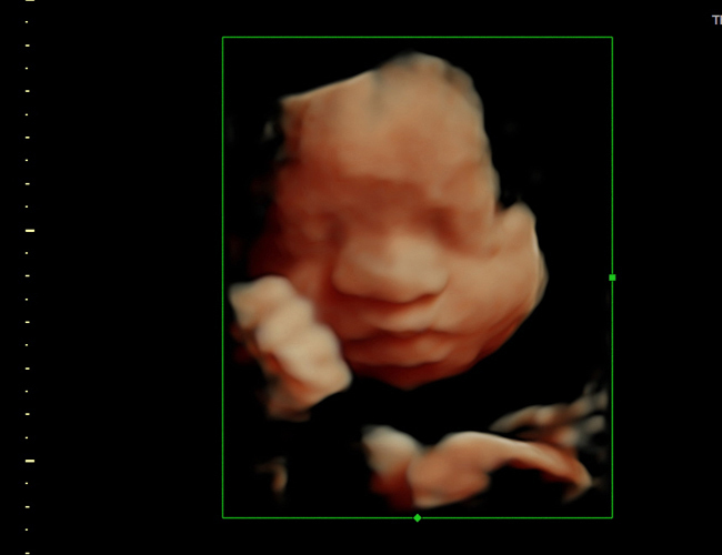 3d sonogram image at HD weeks