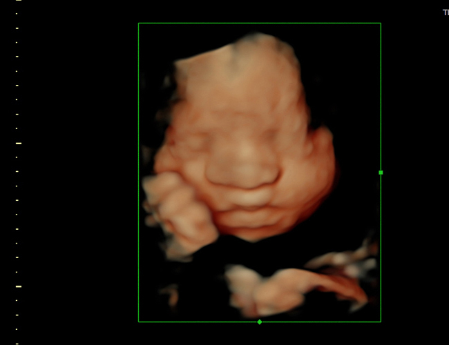 3d sonogram image at HD weeks