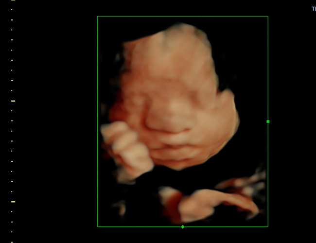 3d sonogram image at HD weeks