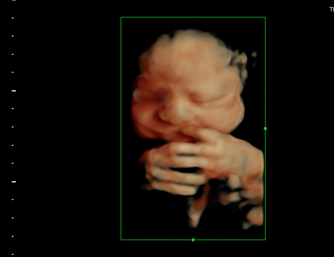 3d sonogram image at HD weeks