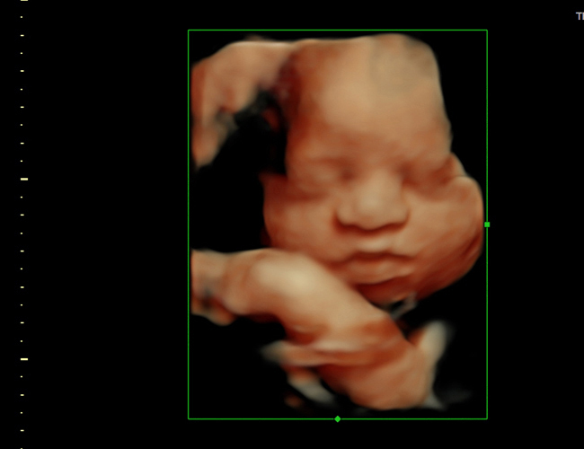 3d sonogram image at HD weeks