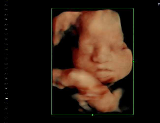 3d sonogram image at HD weeks