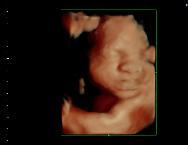 3d sonogram image at HD weeks