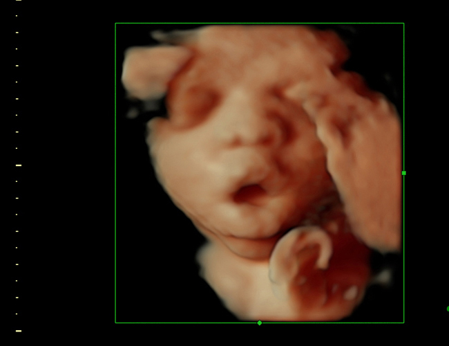 3d sonogram image at HD weeks