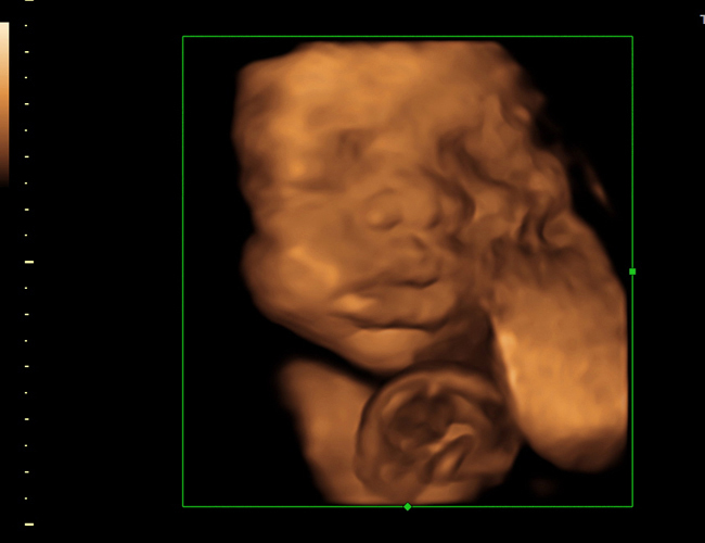 3d sonogram image at HD weeks