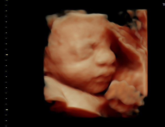 3d sonogram image at HD weeks