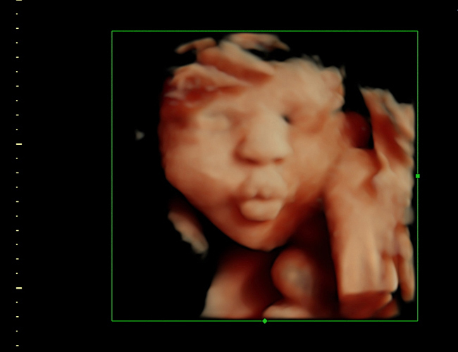 3d sonogram image at HD weeks