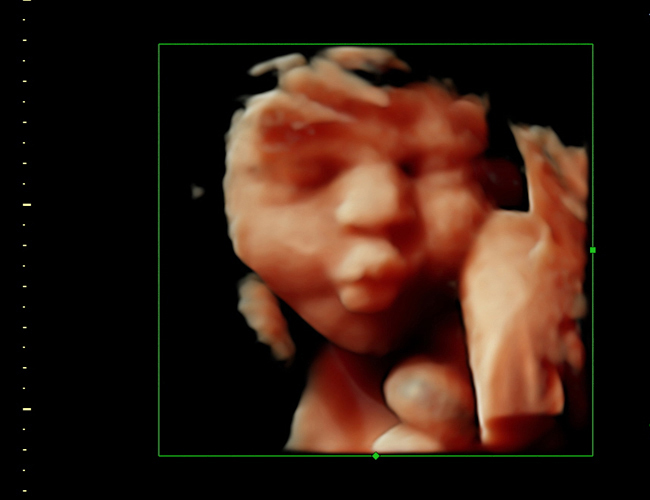 3d sonogram image at HD weeks