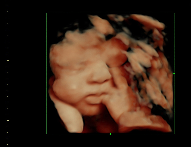 3d sonogram image at HD weeks